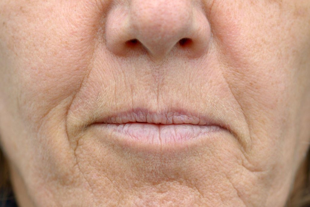 Vertical Lip Lines Treatment In Coomera Curvz Skin Clinic